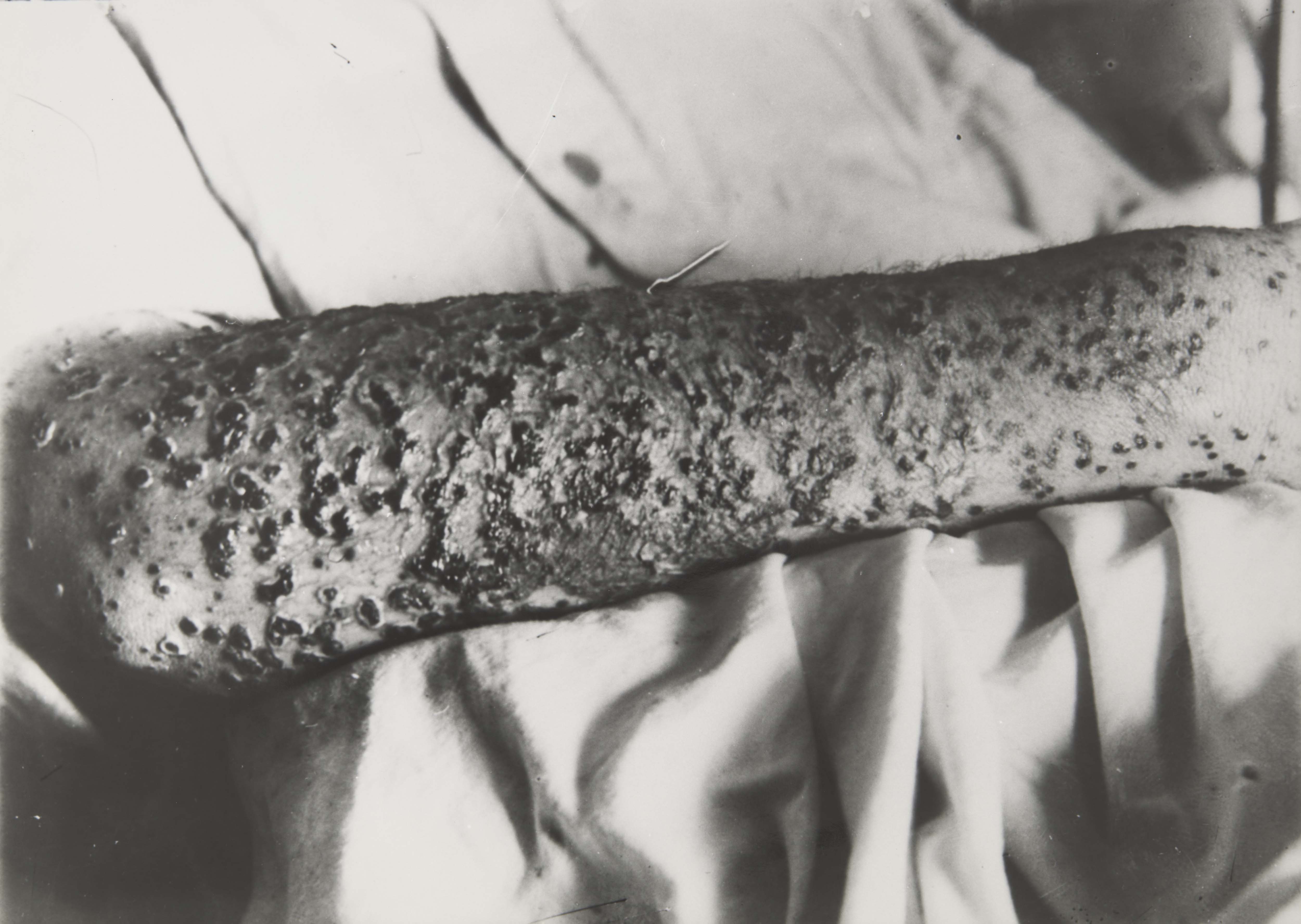 Photograph of the arm of a smallpox patient.