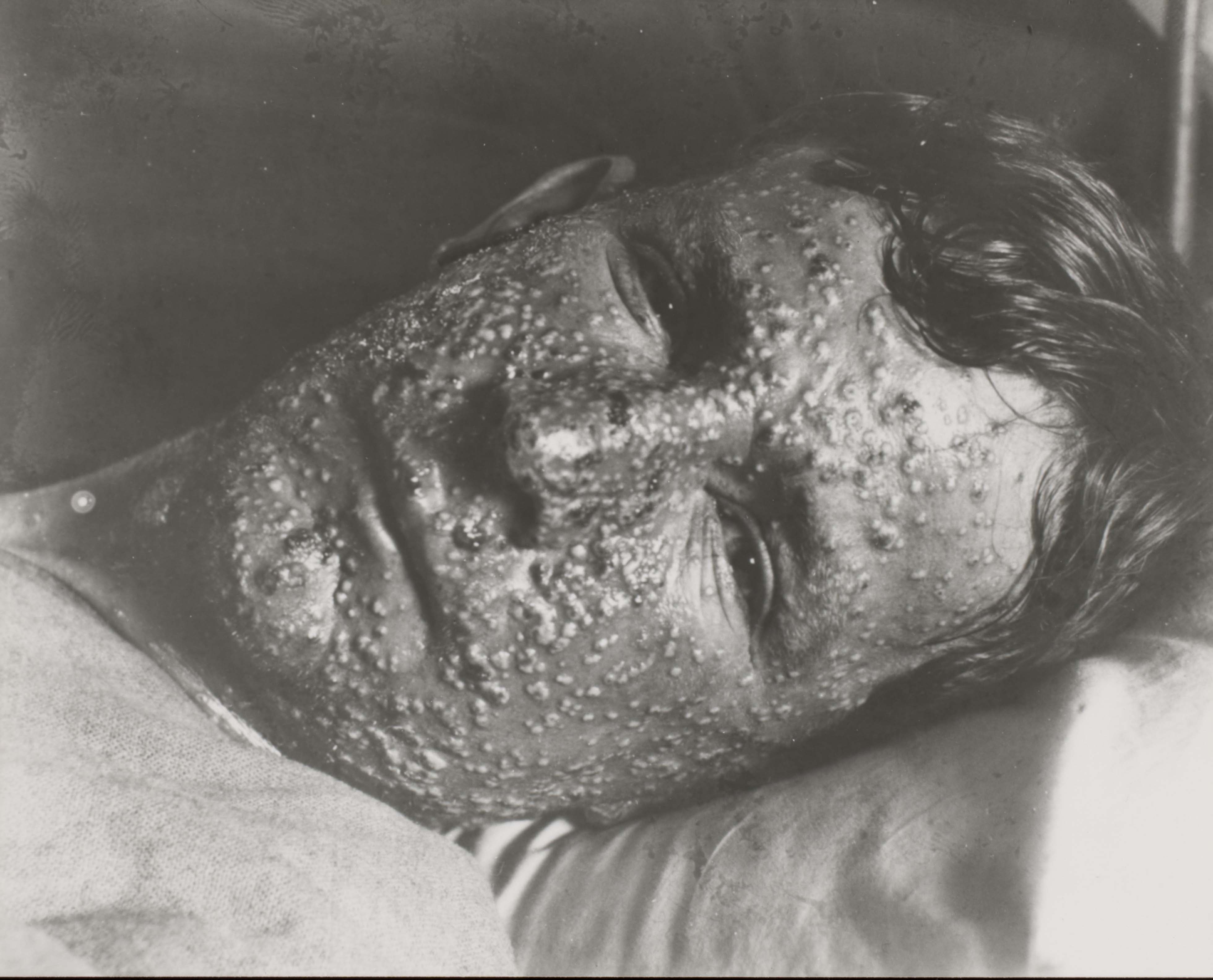 Photograph of the face of a smallpox patient.