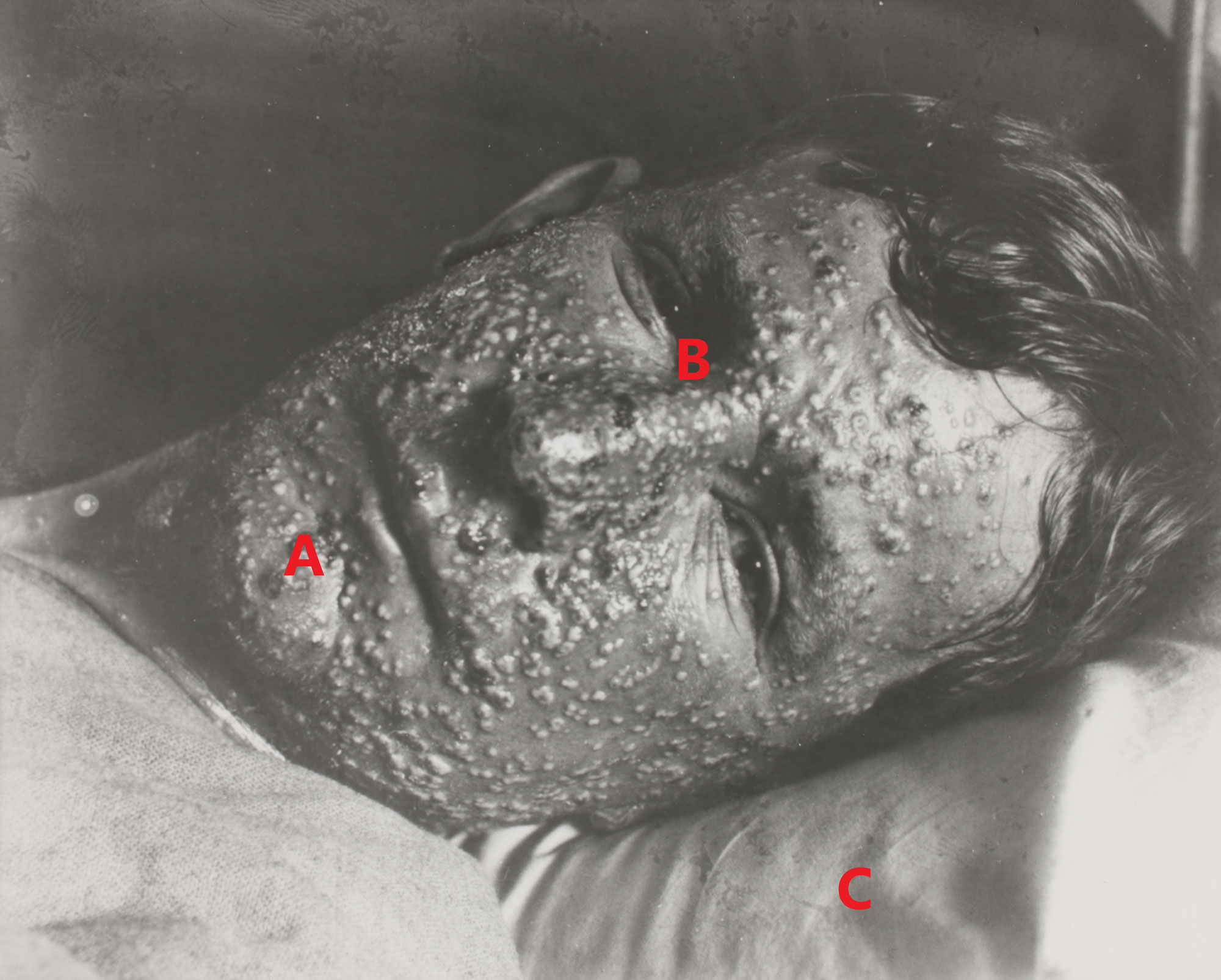 <p>Photograph of the face of a smallpox patient</p>

