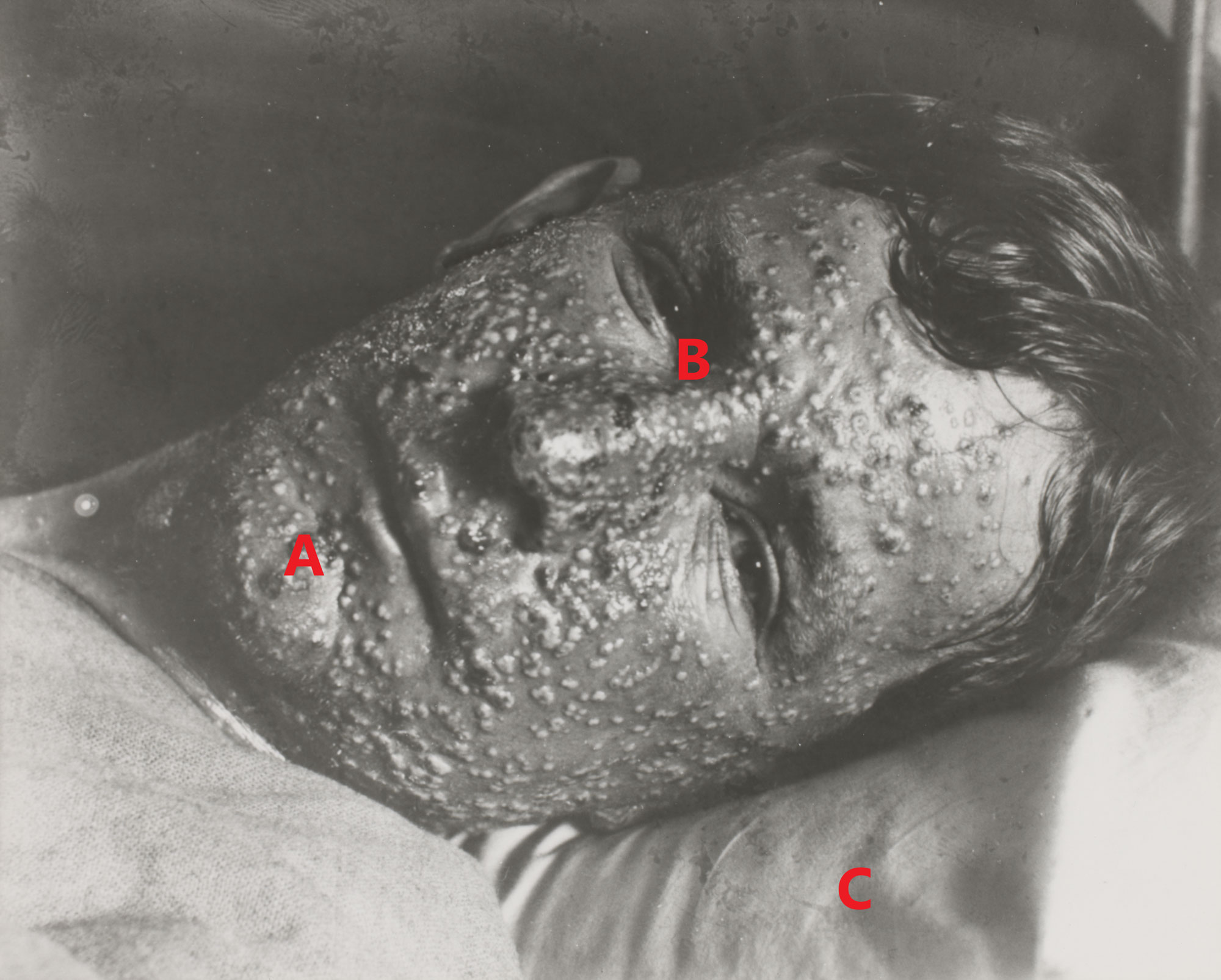 <p>Photograph of the face of a smallpox patient</p>
